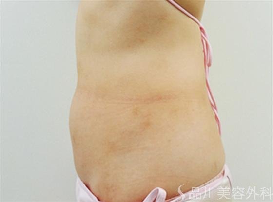 症例NO.17333のBEFORE写真