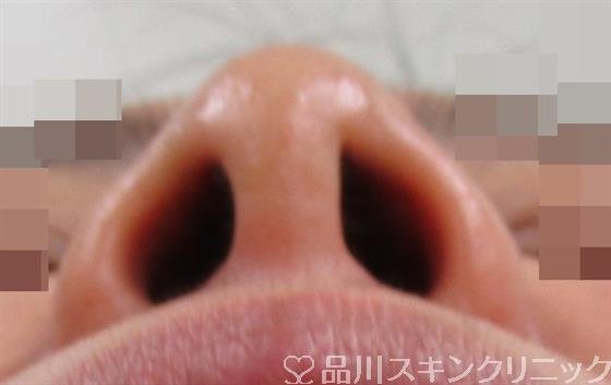 症例NO.34505のAFTER写真
