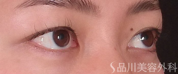 症例NO.70256のBEFORE写真