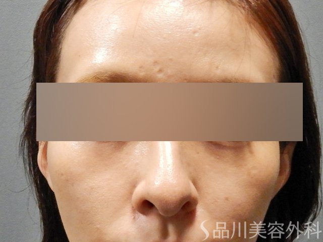 症例NO.67974のBEFORE写真
