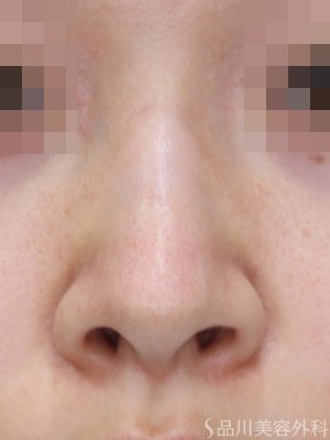 症例NO.72620のBEFORE写真