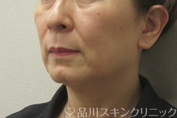 症例NO.74202のBEFORE写真