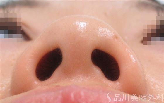 症例NO.22125のBEFORE写真