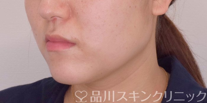 症例NO.68070のAFTER写真