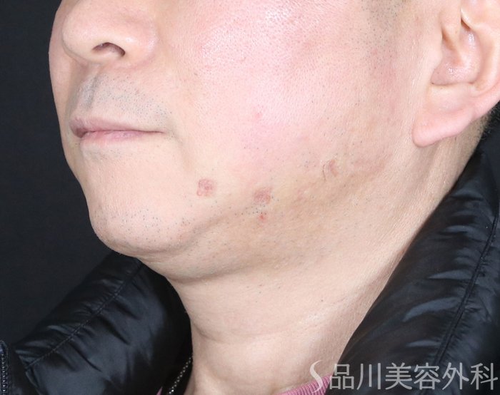 症例NO.72499のAFTER写真