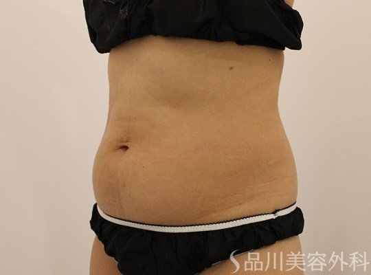 症例NO.71797のBEFORE写真