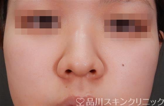 症例NO.56326のBEFORE写真