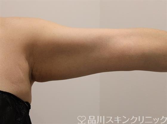 症例NO.44581のAFTER写真
