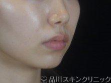 症例NO.74377のBEFORE写真