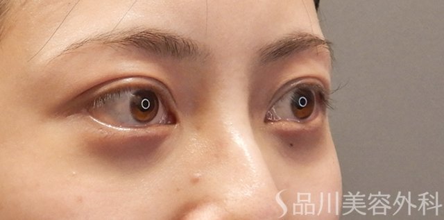 症例NO.74433のAFTER写真