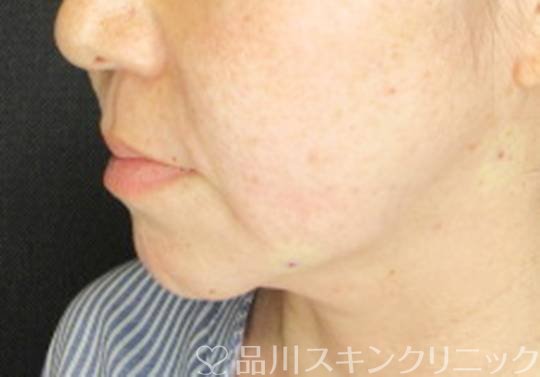 症例NO.75370のAFTER写真