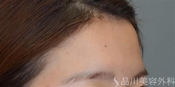 症例NO.51377のBEFORE写真