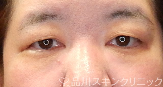 症例NO.64419のBEFORE写真