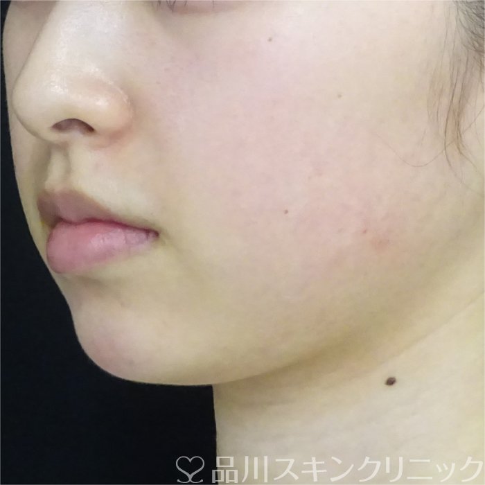 症例NO.69411のAFTER写真