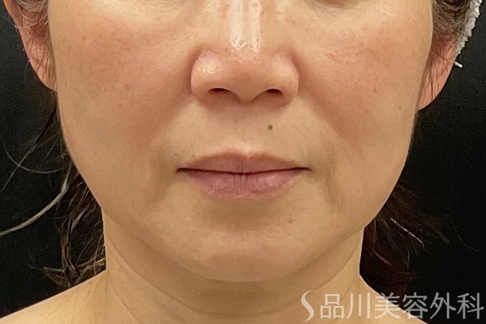 症例NO.73317のBEFORE写真