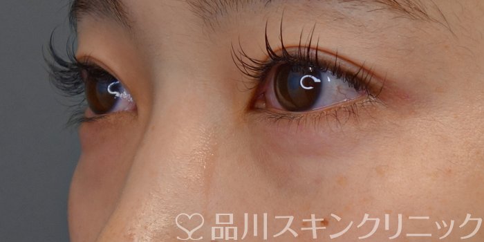 症例NO.72532のBEFORE写真