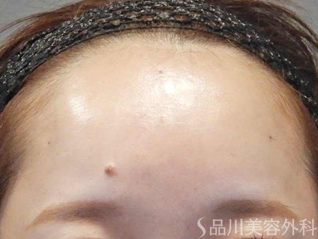 症例NO.64983のAFTER写真