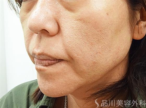 症例NO.33694のBEFORE写真
