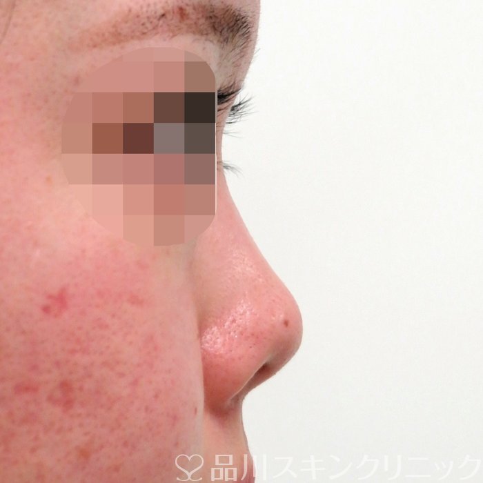 症例NO.71290のBEFORE写真