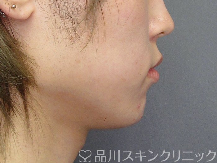 症例NO.75070のAFTER写真
