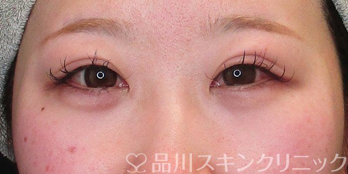 症例NO.73328のAFTER写真