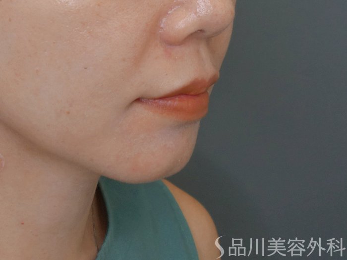 症例NO.71838のBEFORE写真