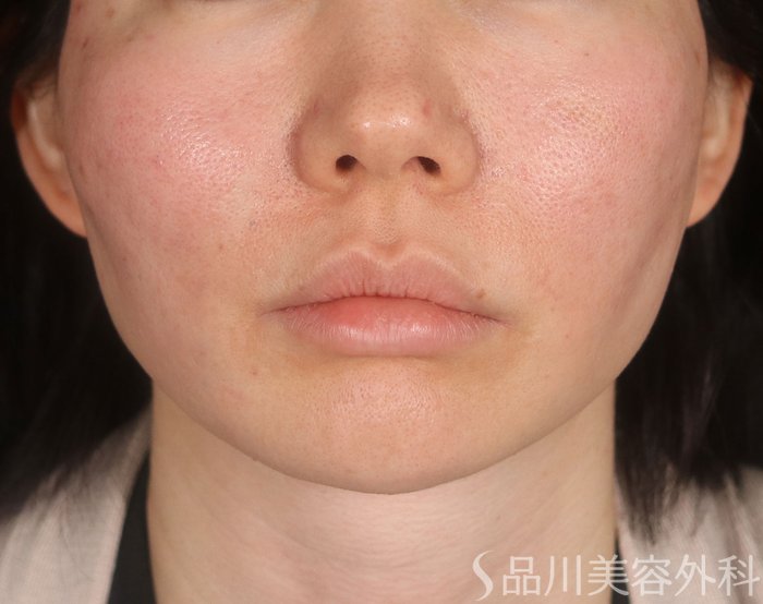 症例NO.73707のAFTER写真