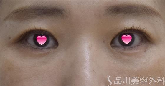 症例NO.47880のAFTER写真