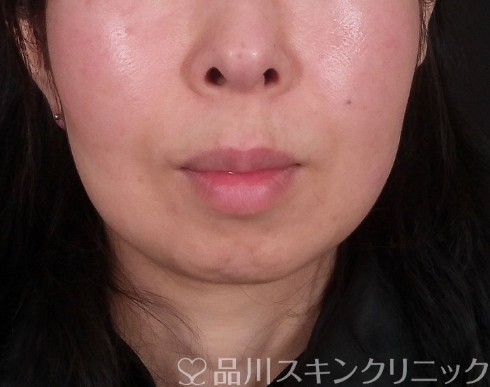 症例NO.69647のAFTER写真