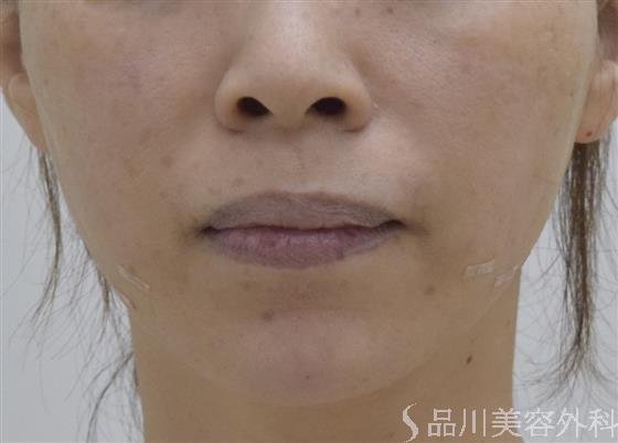 症例NO.50468のAFTER写真