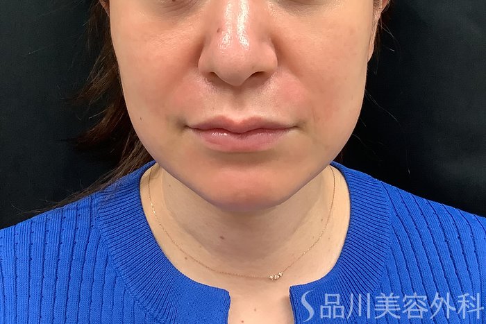 症例NO.71277のAFTER写真