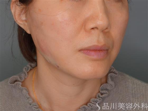 症例NO.53594のAFTER写真
