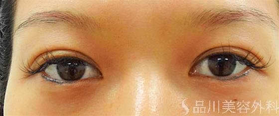 症例NO.25111のAFTER写真