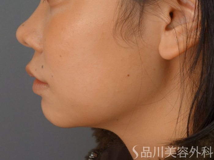 症例NO.73031のBEFORE写真