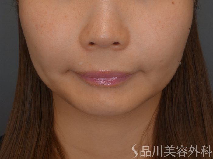 症例NO.65682のBEFORE写真