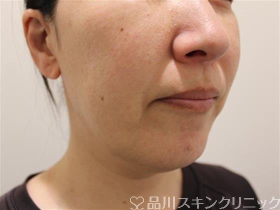 症例NO.45084のAFTER写真