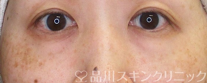 症例NO.63535のBEFORE写真