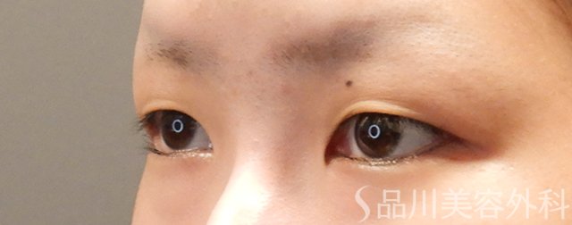 症例NO.72030のBEFORE写真