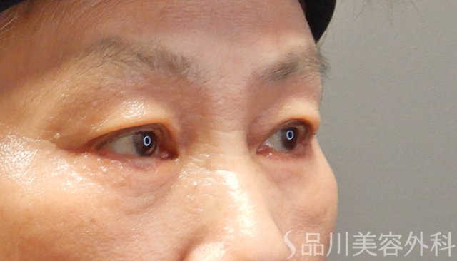症例NO.74809のAFTER写真