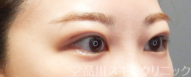 症例NO.75076のAFTER写真
