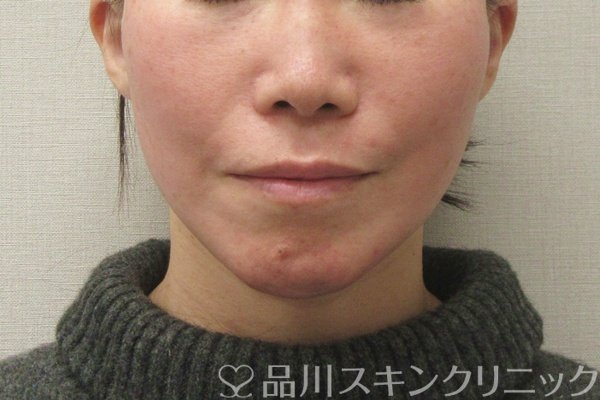 症例NO.75393のAFTER写真