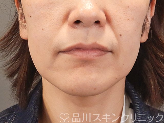 症例NO.75087のBEFORE写真
