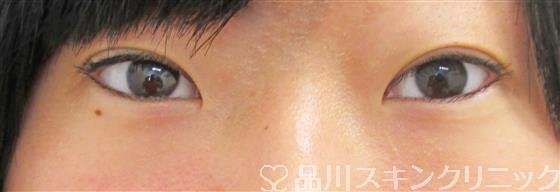 症例NO.44247のAFTER写真