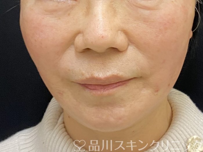 症例NO.73538のAFTER写真