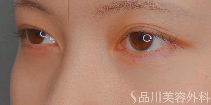 症例NO.73529のAFTER写真