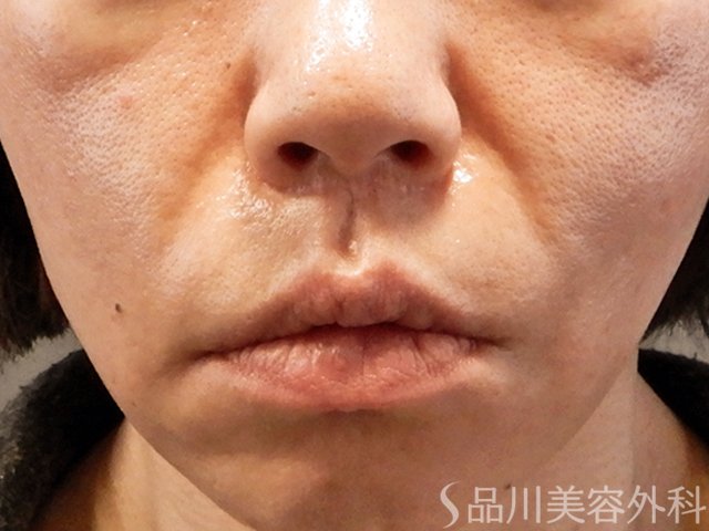 症例NO.69213のBEFORE写真