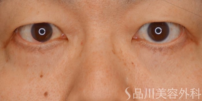 症例NO.64908のAFTER写真
