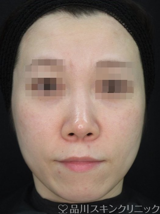 症例NO.73748のBEFORE写真