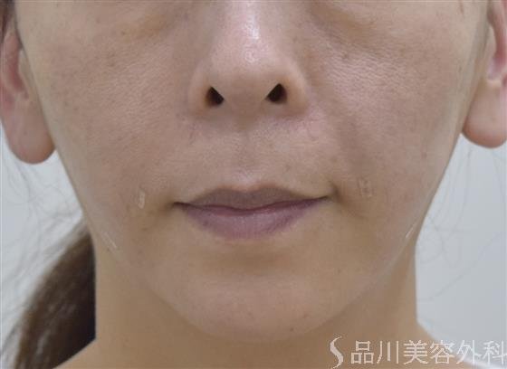 症例NO.48021のAFTER写真