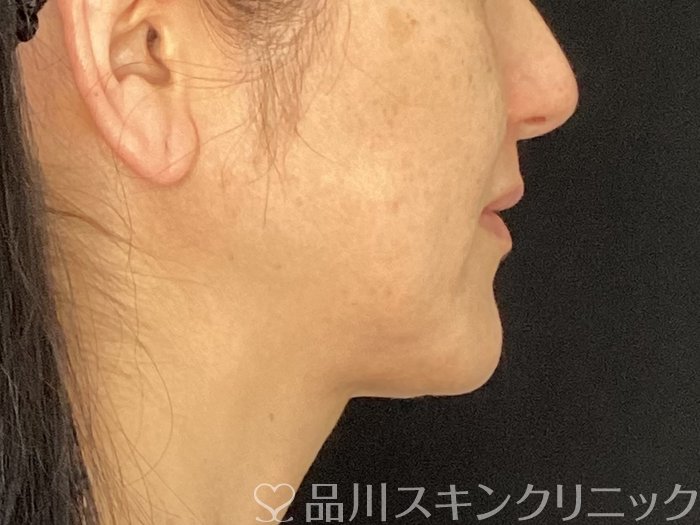 症例NO.72901のBEFORE写真